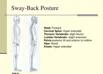 Swayback (Kamburumsu) Duruş Nedir?