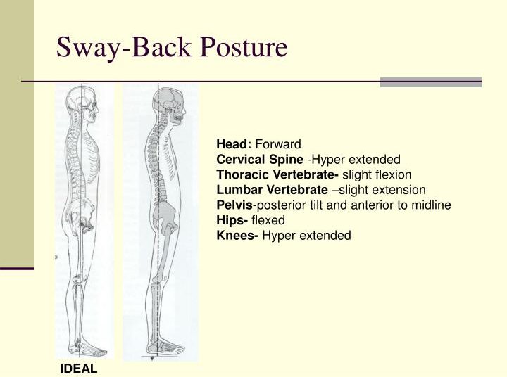 Swayback (Kamburumsu) Duruş Nedir?
