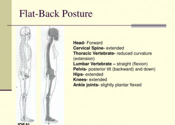 Flat Back Duruş Nedir?