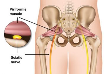 Piriformis Sendromu Nedir?